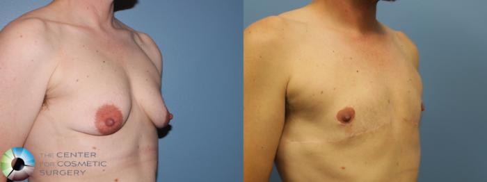 Before & After FTM Top Surgery/Chest Masculinization Case 11468 Right Oblique in Denver and Colorado Springs, CO
