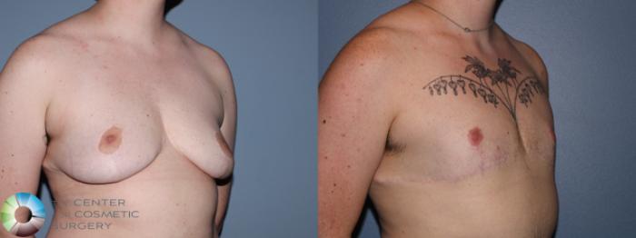Before & After FTM Top Surgery/Chest Masculinization Case 11475 Right Oblique in Denver and Colorado Springs, CO