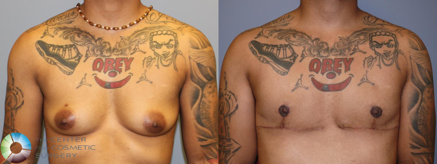 Before & After FTM Top Surgery/Chest Masculinization Case 11476 Front in Denver and Colorado Springs, CO