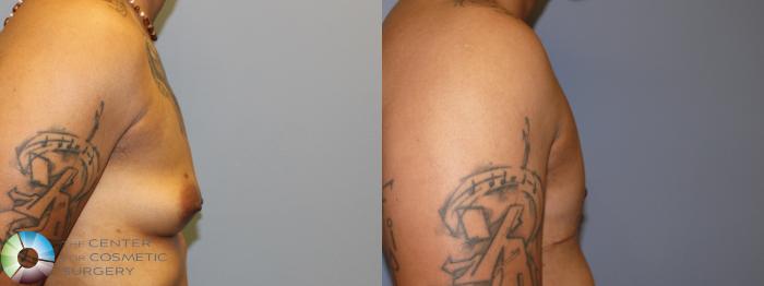 Before & After FTM Top Surgery/Chest Masculinization Case 11476 Right Side View in Golden, CO