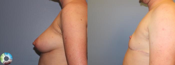 Before & After FTM Top Surgery/Chest Masculinization Case 11483 Left Side View in Golden, CO