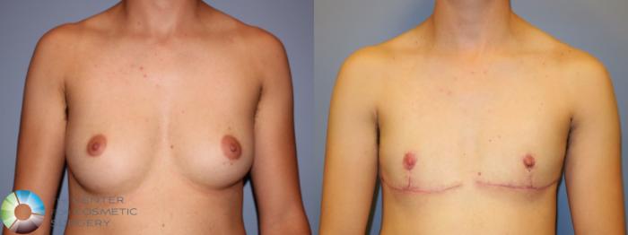Before & After FTM Top Surgery/Chest Masculinization Case 11543 Front in Denver and Colorado Springs, CO