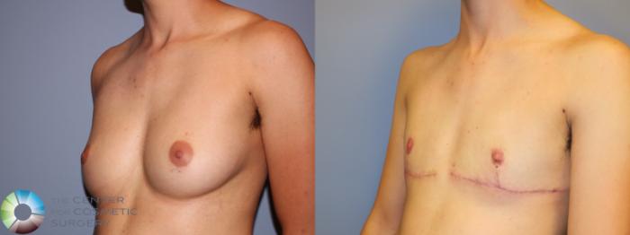 Before & After FTM Top Surgery/Chest Masculinization Case 11543 Left Oblique in Denver and Colorado Springs, CO