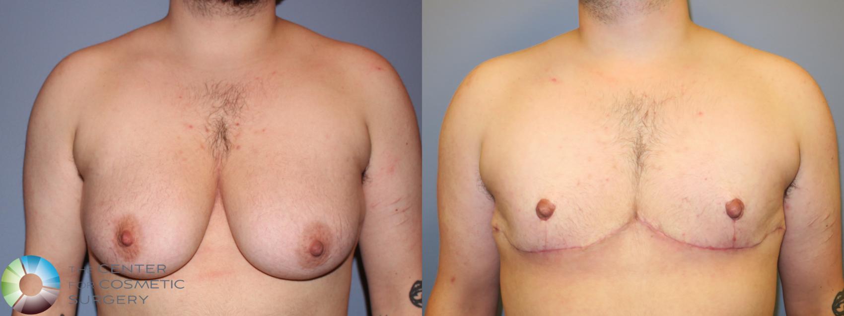 Before & After FTM Top Surgery/Chest Masculinization Case 11545 Front in Denver and Colorado Springs, CO