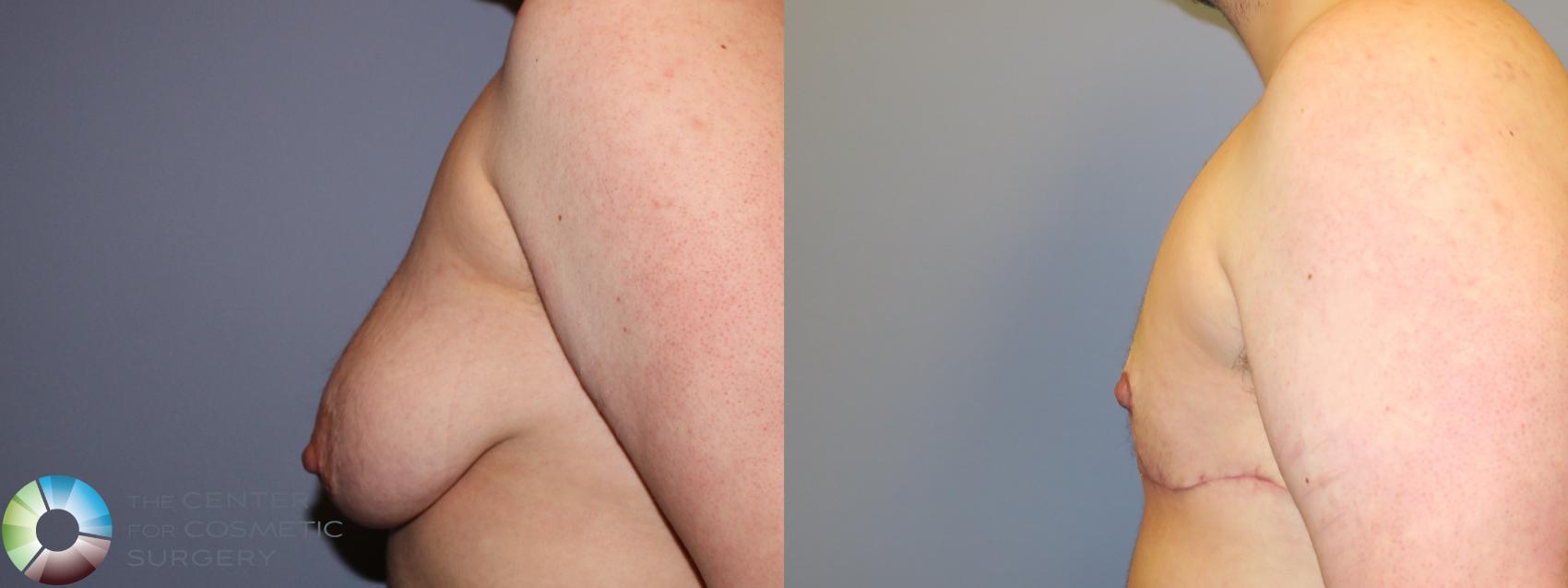 Before & After FTM Top Surgery/Chest Masculinization Case 11545 Left Side in Denver and Colorado Springs, CO