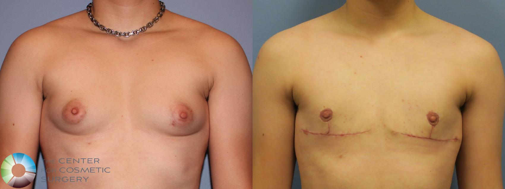 Before & After FTM Top Surgery/Chest Masculinization Case 11642 Front in Denver and Colorado Springs, CO