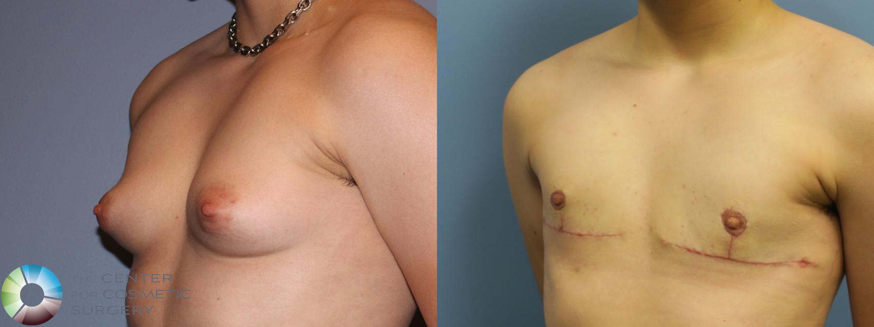 Before & After FTM Top Surgery/Chest Masculinization Case 11642 Left Oblique in Denver and Colorado Springs, CO