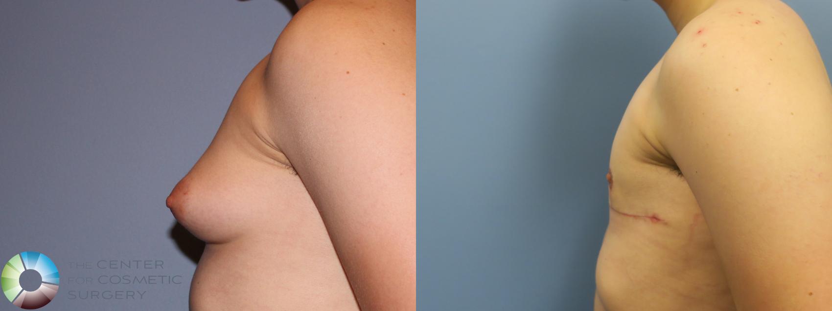 Before & After FTM Top Surgery/Chest Masculinization Case 11642 Left Side in Denver and Colorado Springs, CO