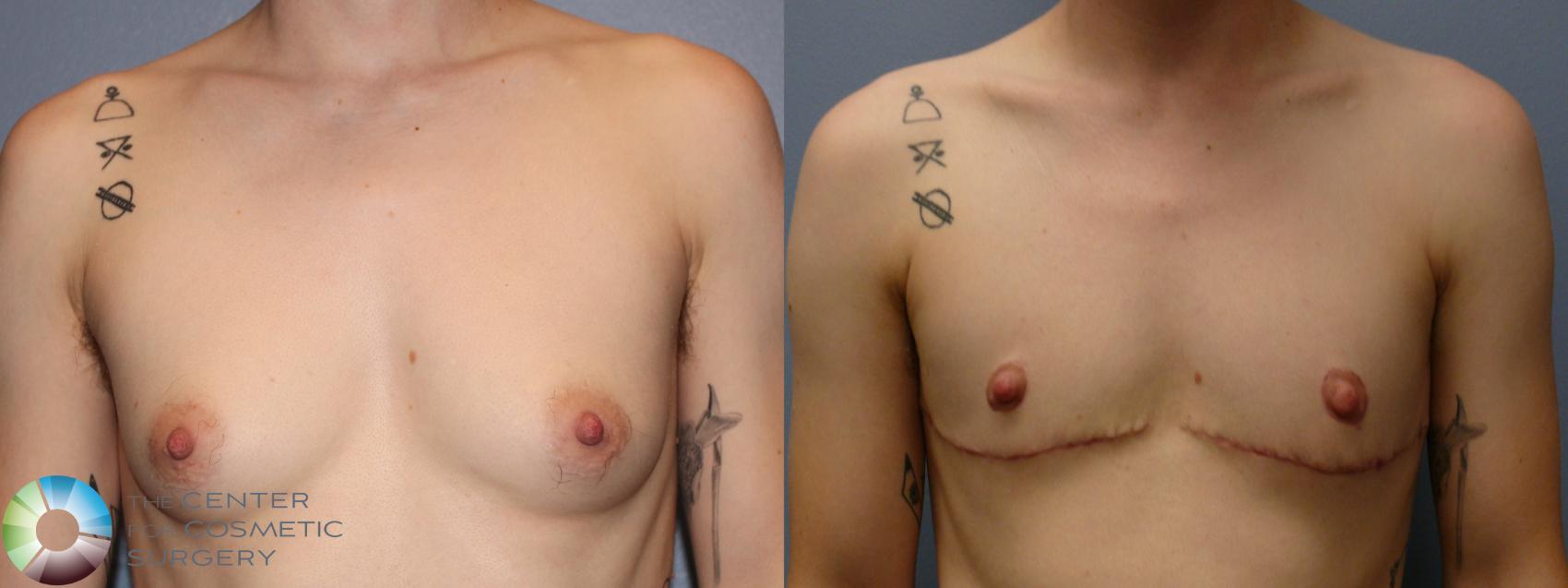 Before & After FTM Top Surgery/Chest Masculinization Case 11643 Front in Denver and Colorado Springs, CO