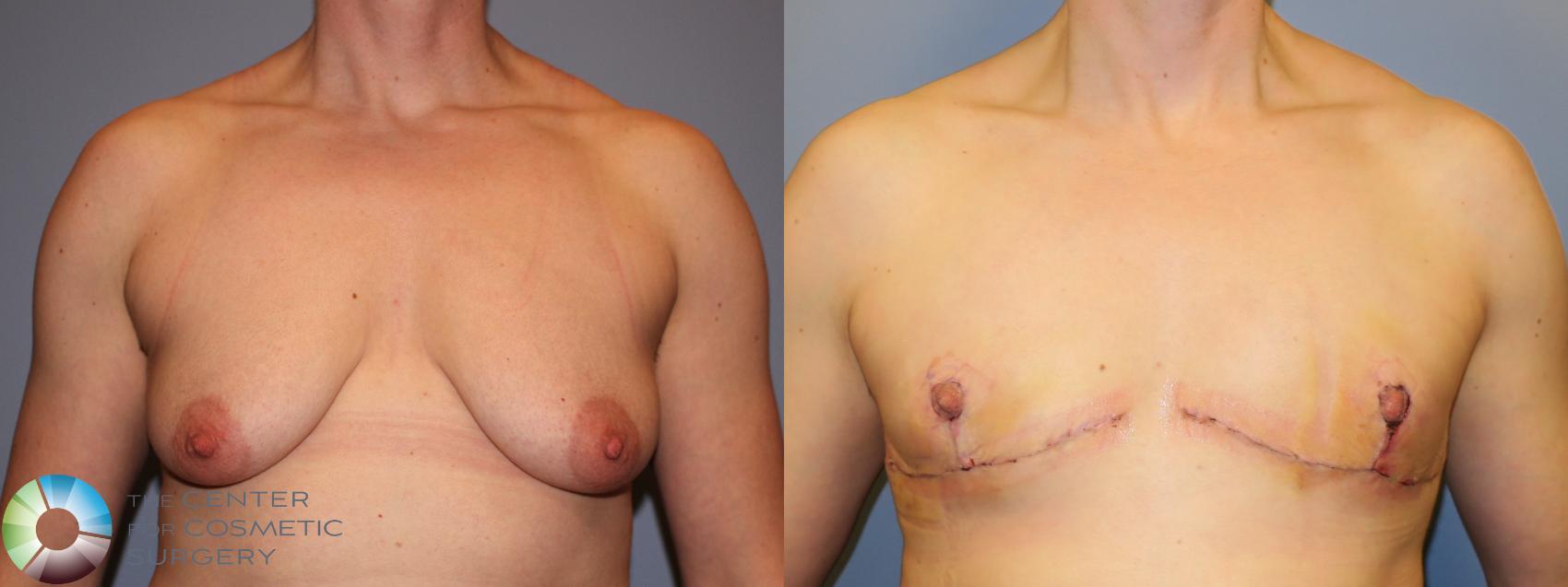 Before & After FTM Top Surgery/Chest Masculinization Case 11645 Front in Denver and Colorado Springs, CO