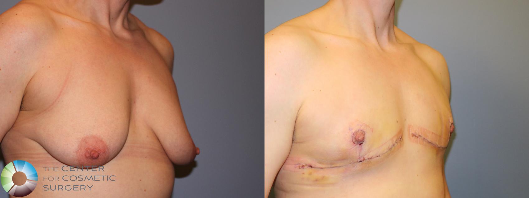 Before & After FTM Top Surgery/Chest Masculinization Case 11645 Right Oblique in Denver and Colorado Springs, CO