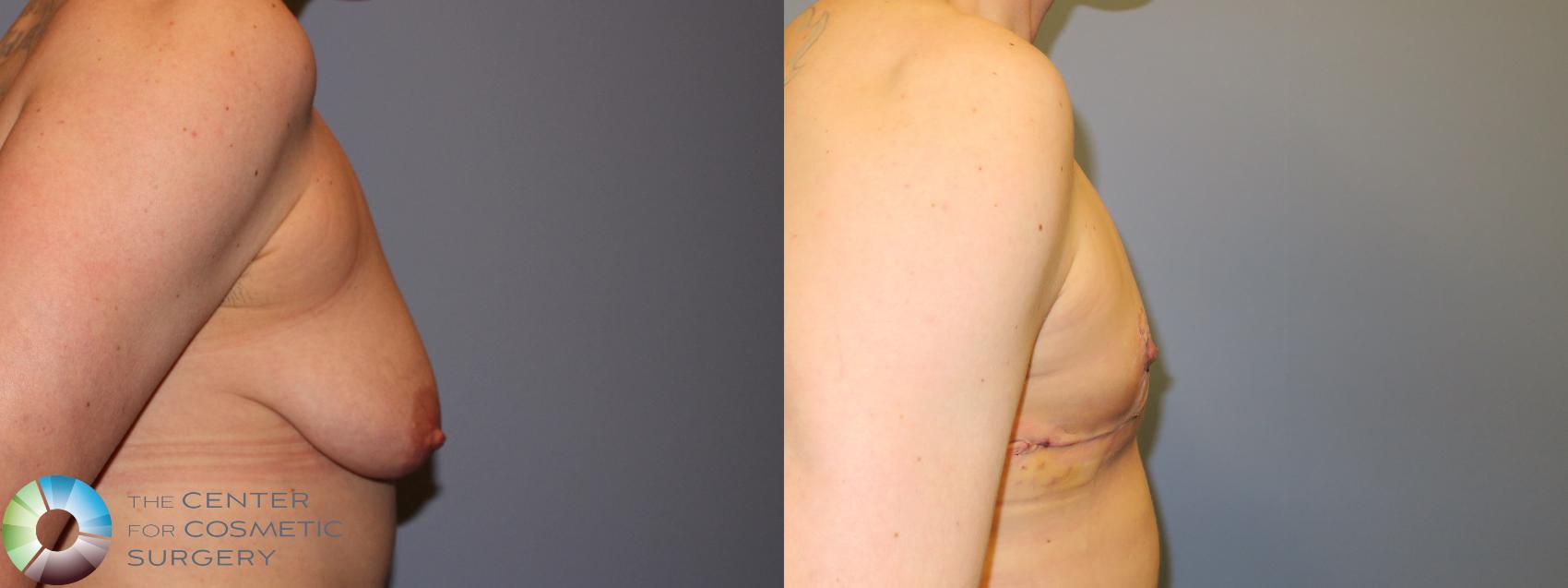 Before & After FTM Top Surgery/Chest Masculinization Case 11645 Right Side in Denver and Colorado Springs, CO