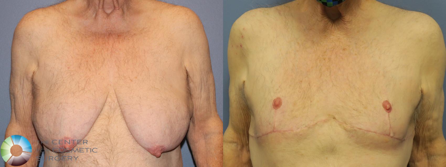 Before & After FTM Top Surgery/Chest Masculinization Case 11646 Front in Denver and Colorado Springs, CO