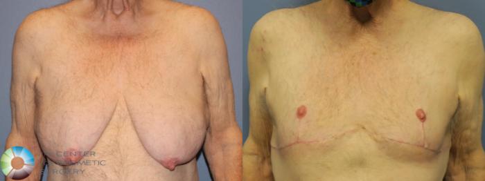 Before & After FTM Top Surgery/Chest Masculinization Case 11646 Front View in Golden, CO