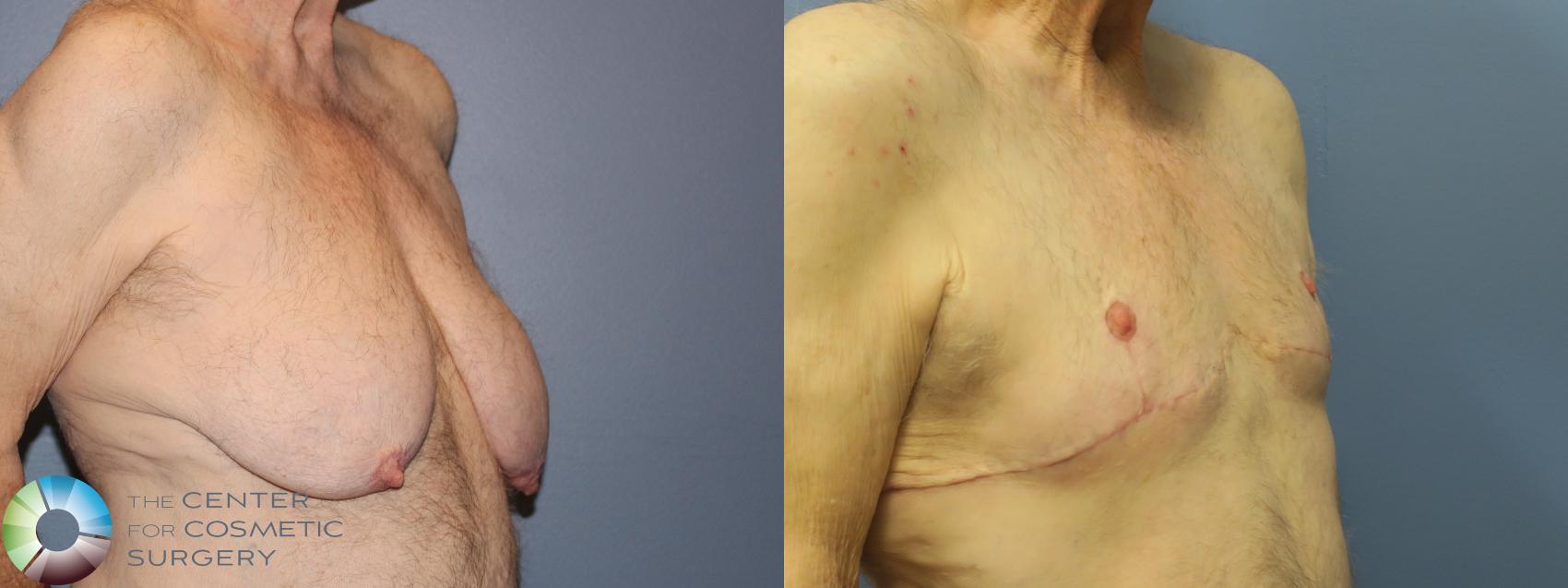 Best USA Top Surgery Chest Masculinization