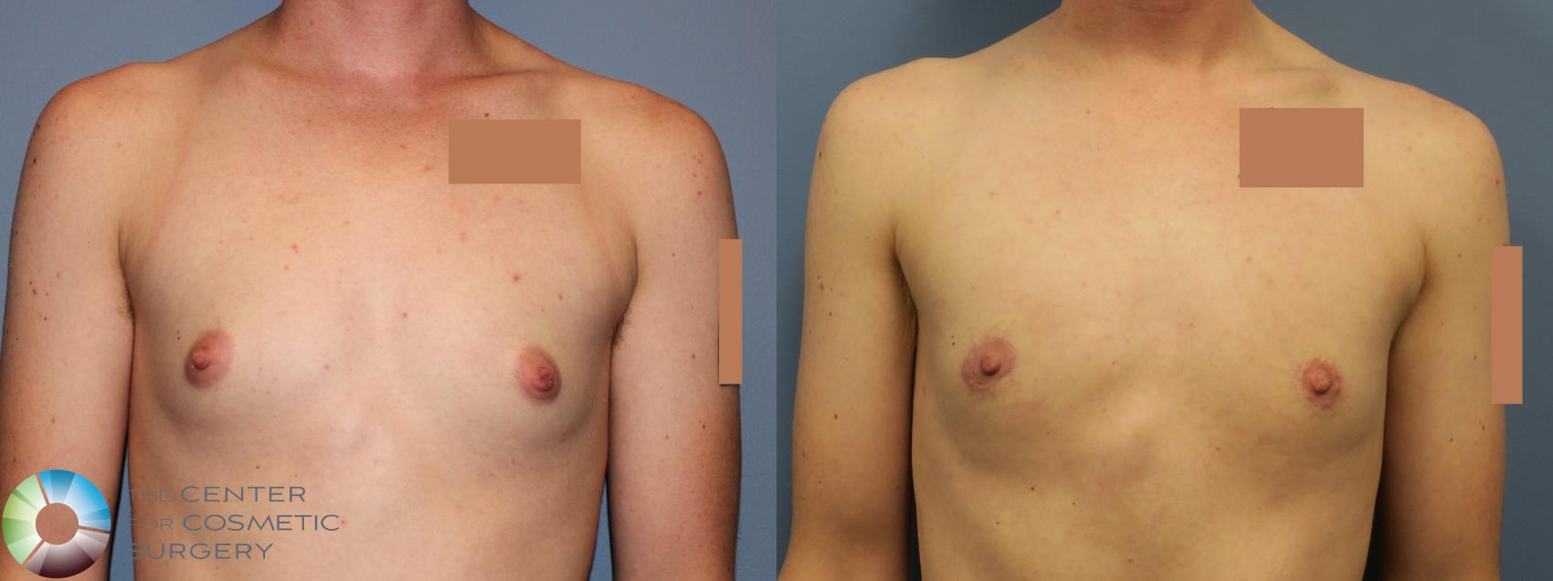 Before & After FTM Top Surgery/Chest Masculinization Case 11783 Front in Denver and Colorado Springs, CO