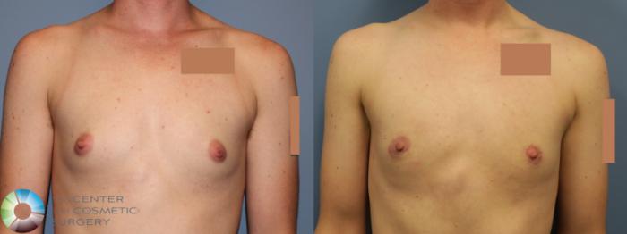 Before & After FTM Top Surgery/Chest Masculinization Case 11783 Front in Denver, CO