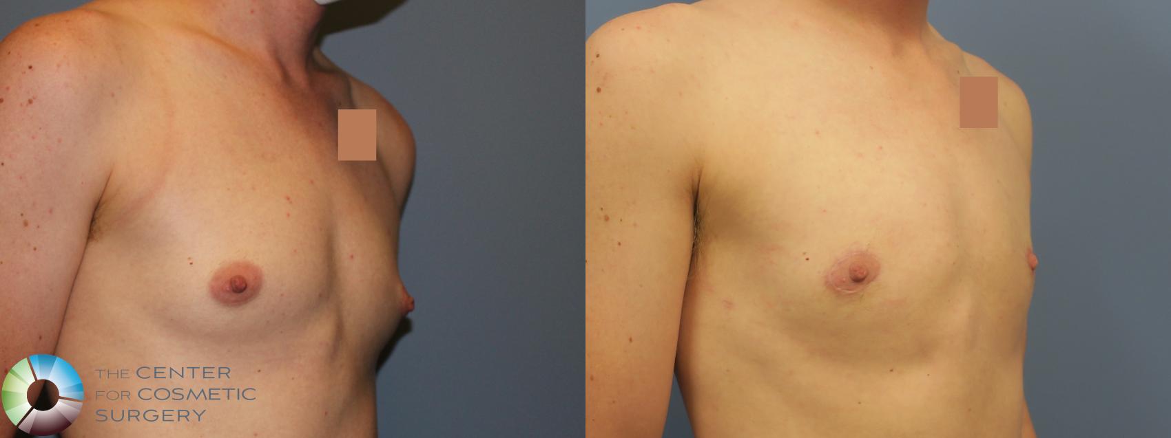 Before & After FTM Top Surgery/Chest Masculinization Case 11783 Right Oblique in Denver, CO