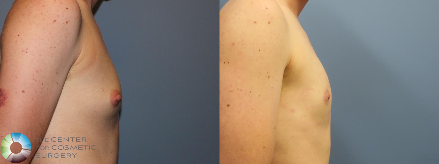 Before & After FTM Top Surgery/Chest Masculinization Case 11783 Right Side in Denver and Colorado Springs, CO