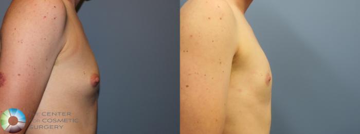 Before & After FTM Top Surgery/Chest Masculinization Case 11783 Right Side in Denver, CO