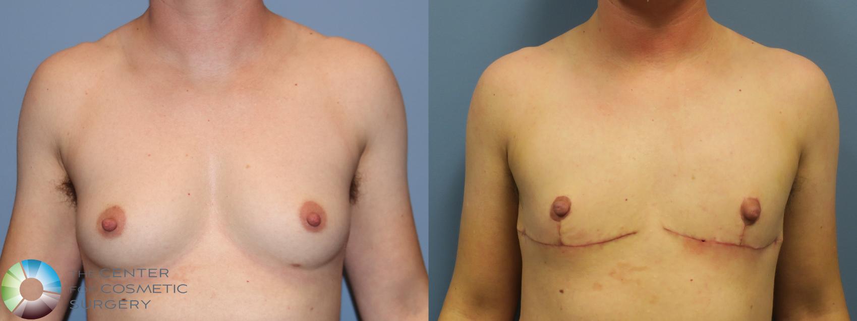 Before & After FTM Top Surgery/Chest Masculinization Case 11784 Front View in Golden, CO