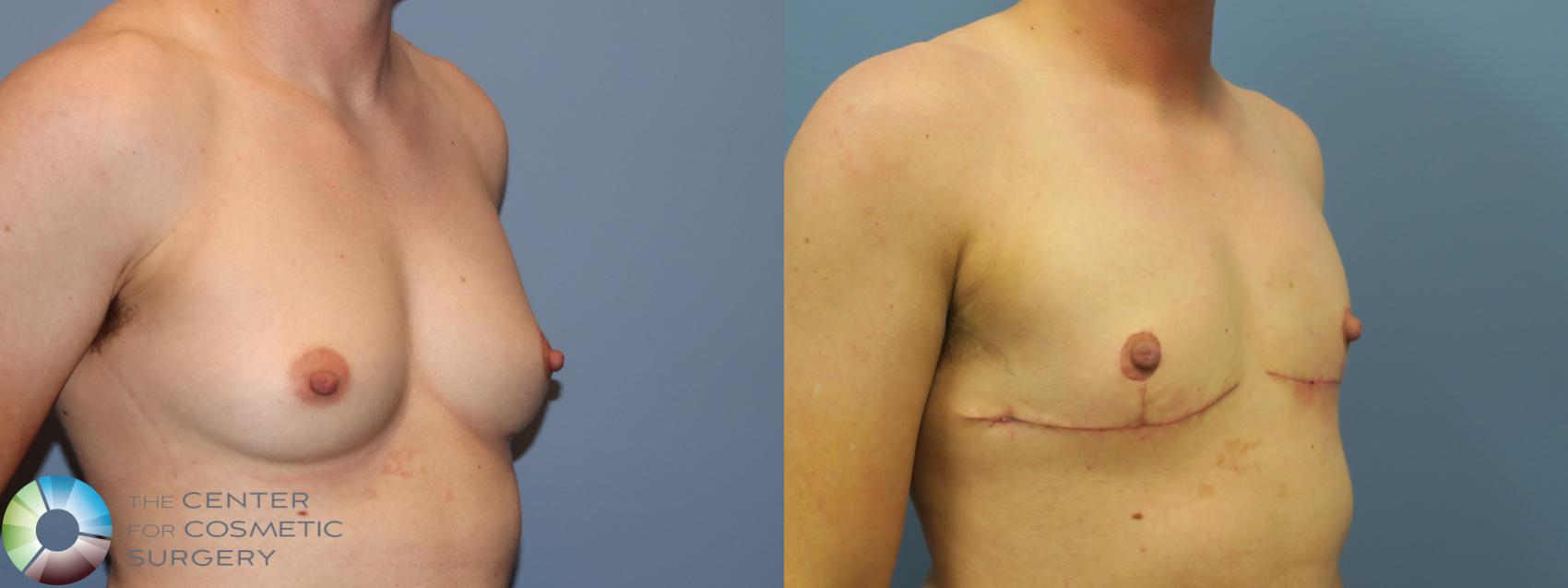 Before & After FTM Top Surgery/Chest Masculinization Case 11784 Right Oblique in Denver and Colorado Springs, CO