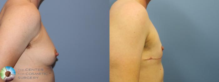 Before & After FTM Top Surgery/Chest Masculinization Case 11784 Right Side View in Golden, CO