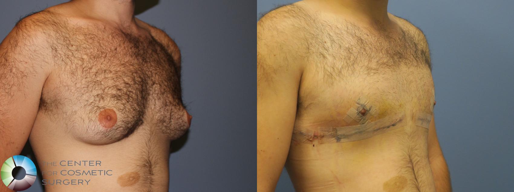 Before & After FTM Top Surgery/Chest Masculinization Case 12031 Right Oblique in Denver and Colorado Springs, CO