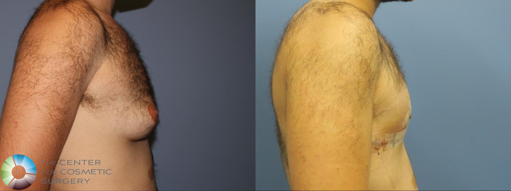 Before & After FTM Top Surgery/Chest Masculinization Case 12031 Right Side in Denver and Colorado Springs, CO