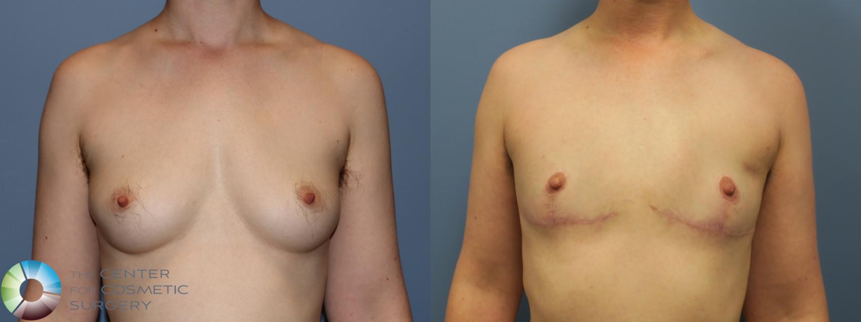 Before & After FTM Top Surgery/Chest Masculinization Case 12039 Front in Denver and Colorado Springs, CO