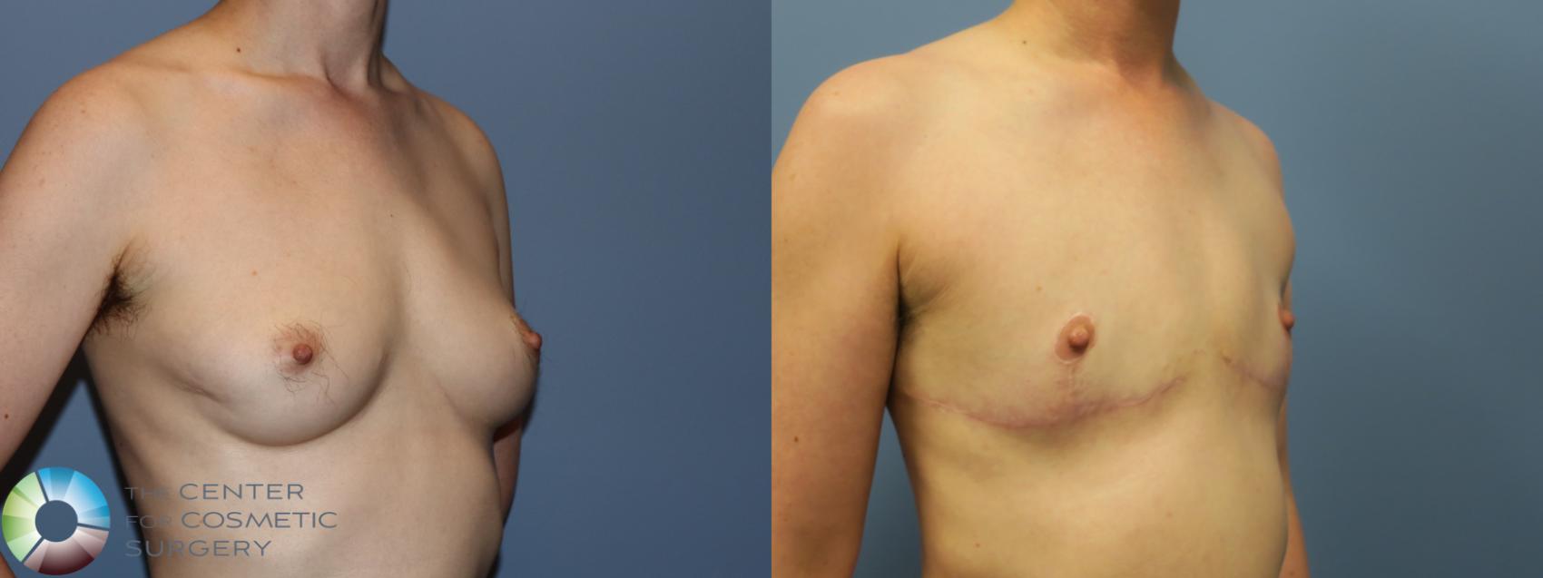 Before & After FTM Top Surgery/Chest Masculinization Case 12039 Right Oblique in Denver and Colorado Springs, CO