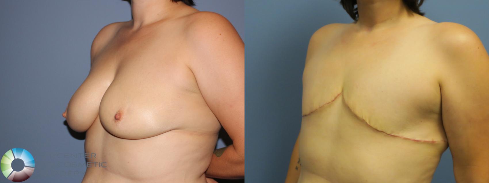 Before & After FTM Top Surgery/Chest Masculinization Case 12040 Left Oblique in Denver and Colorado Springs, CO