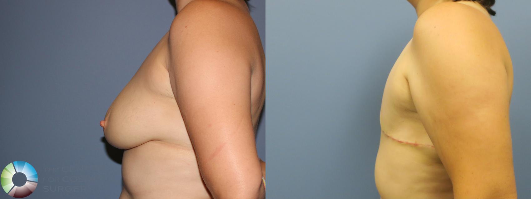 Before & After FTM Top Surgery/Chest Masculinization Case 12040 Left Side in Denver and Colorado Springs, CO