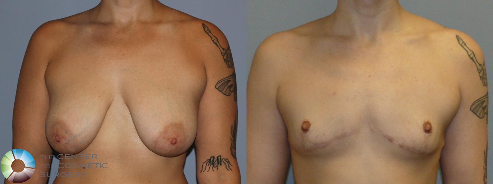 Before & After FTM Top Surgery/Chest Masculinization Case 12041 Front in Denver and Colorado Springs, CO