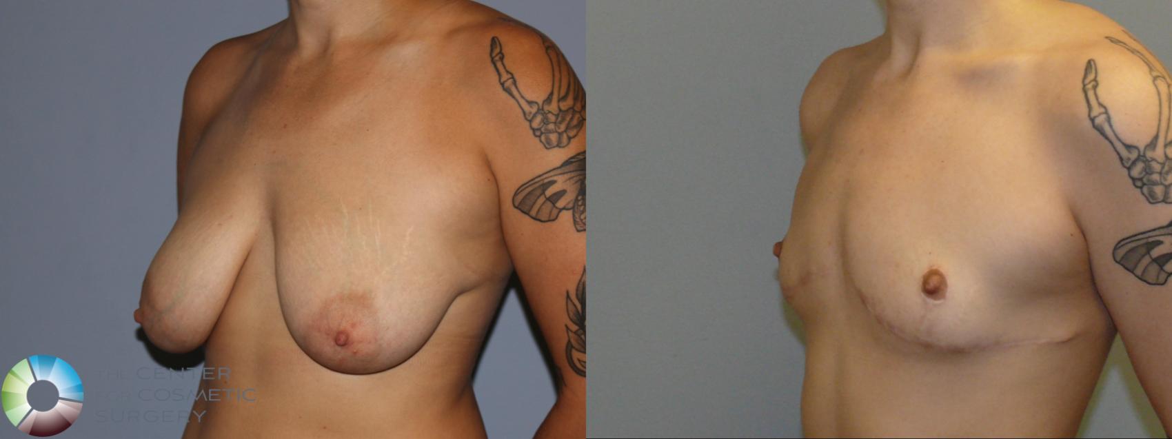 Before & After FTM Top Surgery/Chest Masculinization Case 12041 Left Oblique in Denver and Colorado Springs, CO