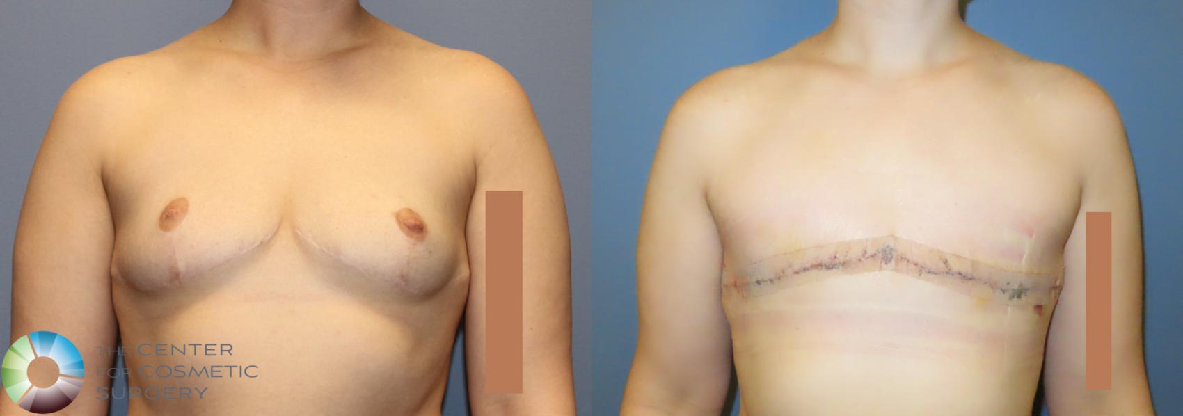 Before & After FTM Top Surgery/Chest Masculinization Case 12042 FTM revision pre/post in Denver and Colorado Springs, CO