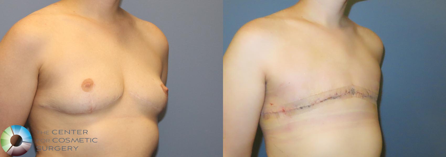 Before & After FTM Top Surgery/Chest Masculinization Case 12042 FTM Revision R oblique before/after in Denver and Colorado Springs, CO