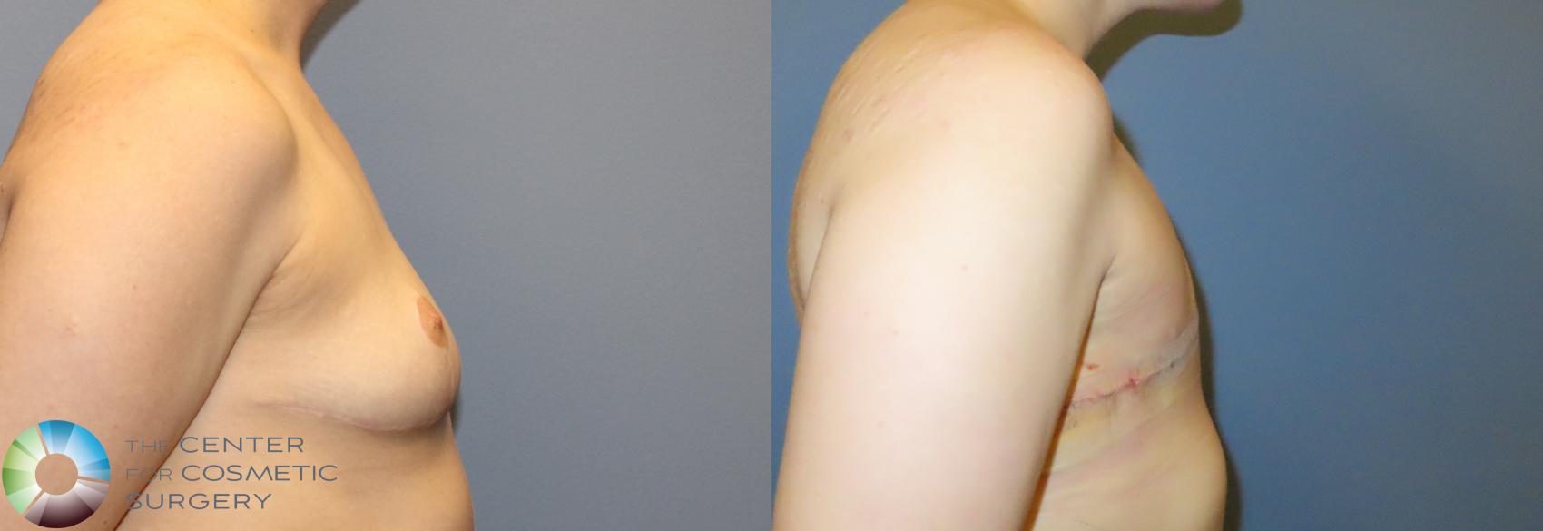 Before & After FTM Top Surgery/Chest Masculinization Case 12042 FTM Revision R side pre/post in Denver and Colorado Springs, CO