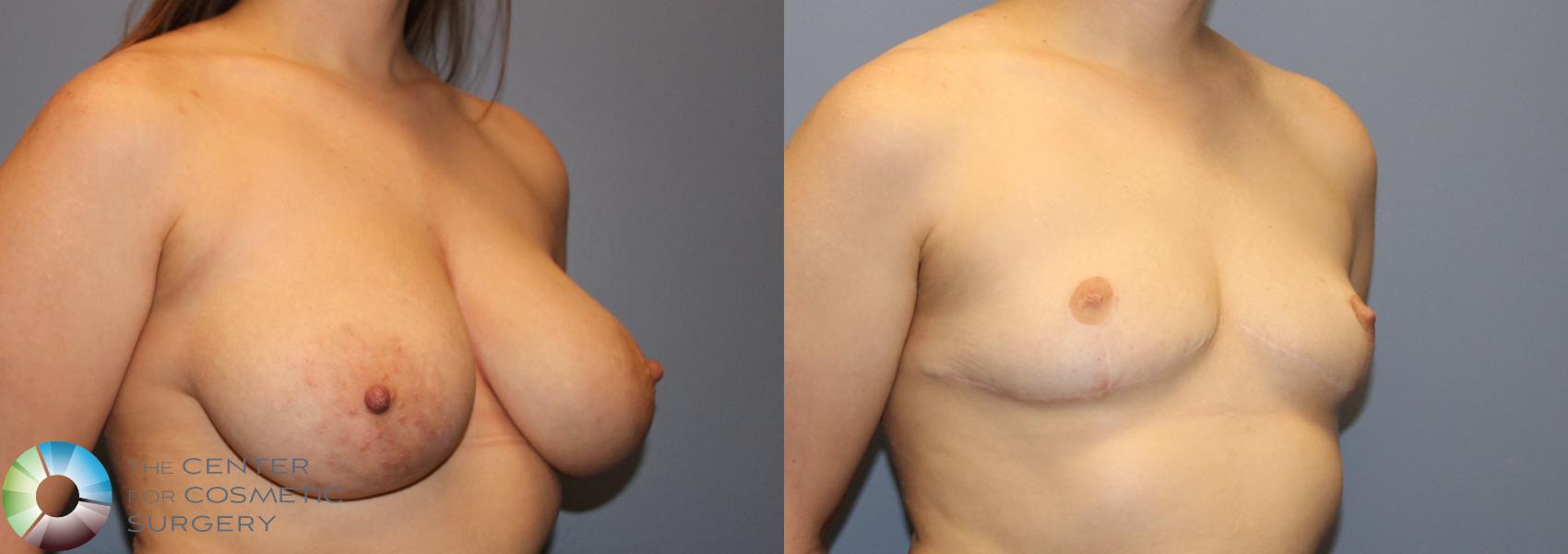 Before & After FTM Top Surgery/Chest Masculinization Case 12042 Right Oblique in Denver and Colorado Springs, CO