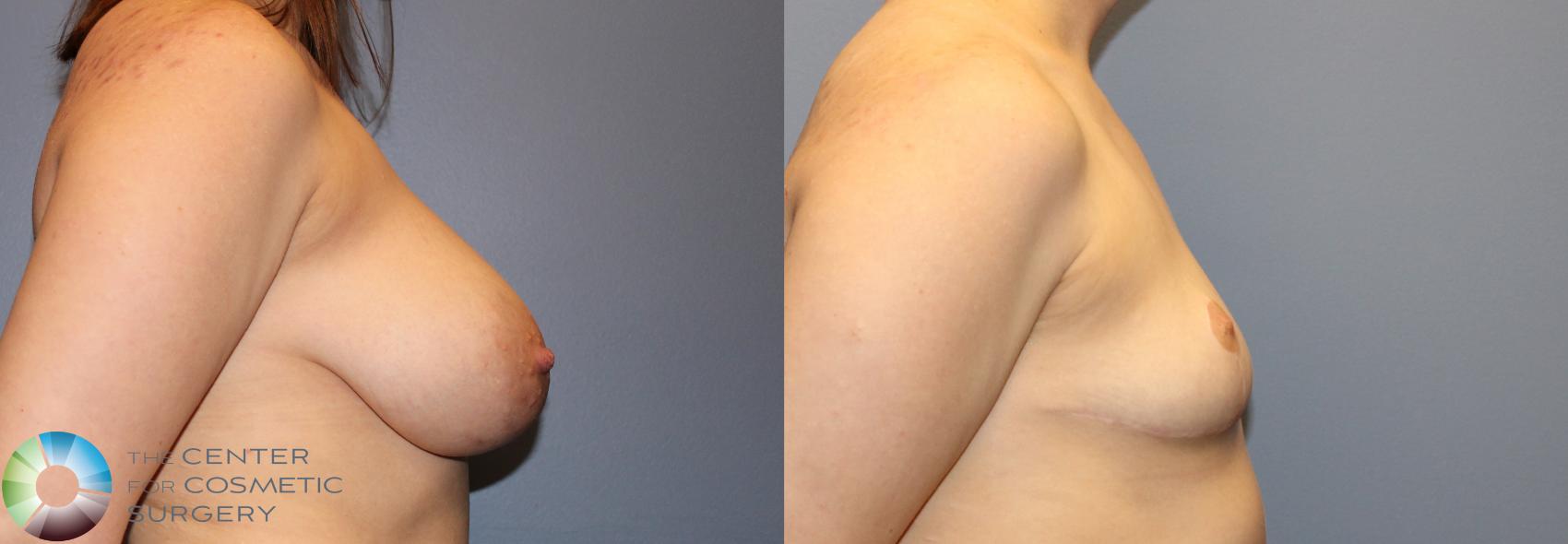 Before & After FTM Top Surgery/Chest Masculinization Case 12042 Right Side in Denver and Colorado Springs, CO