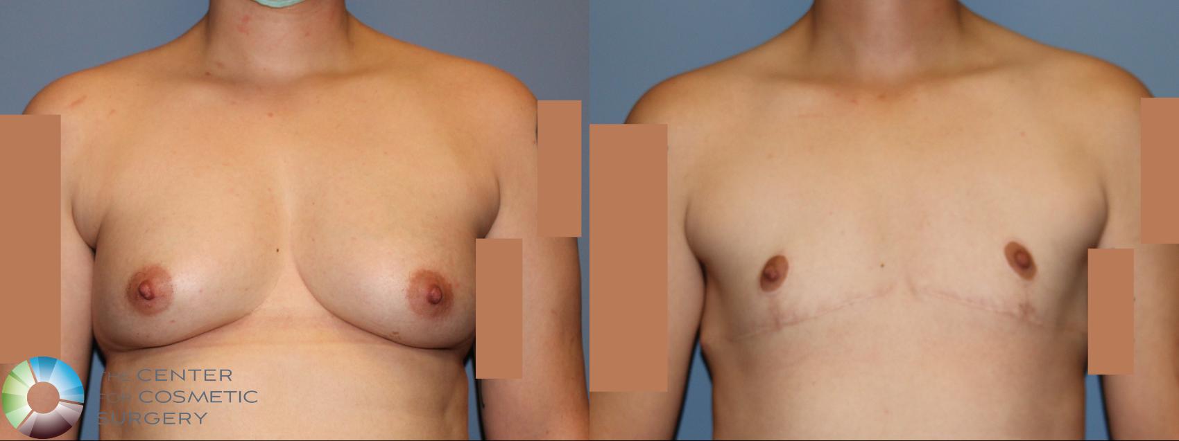 Best Denver Top Surgery/Chest Masculinization 