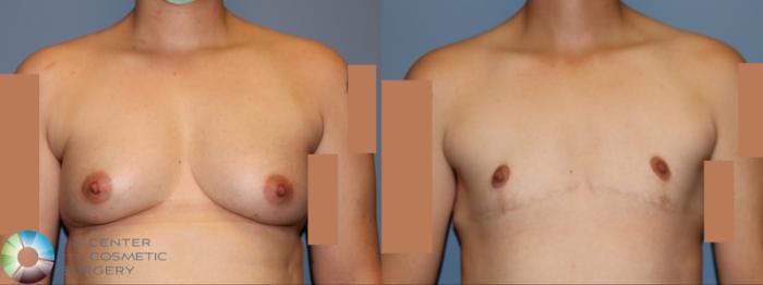 Best Denver Top Surgery/Chest Masculinization 