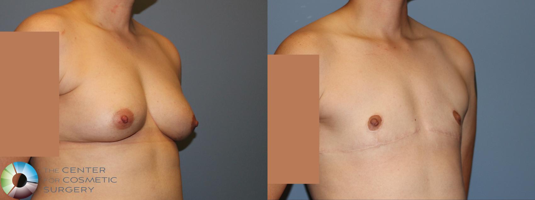 Before & After FTM Top Surgery/Chest Masculinization Case 12044 Right Oblique in Denver and Colorado Springs, CO