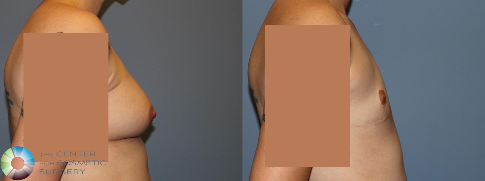 Before & After FTM Top Surgery/Chest Masculinization Case 12044 Right Side in Denver and Colorado Springs, CO