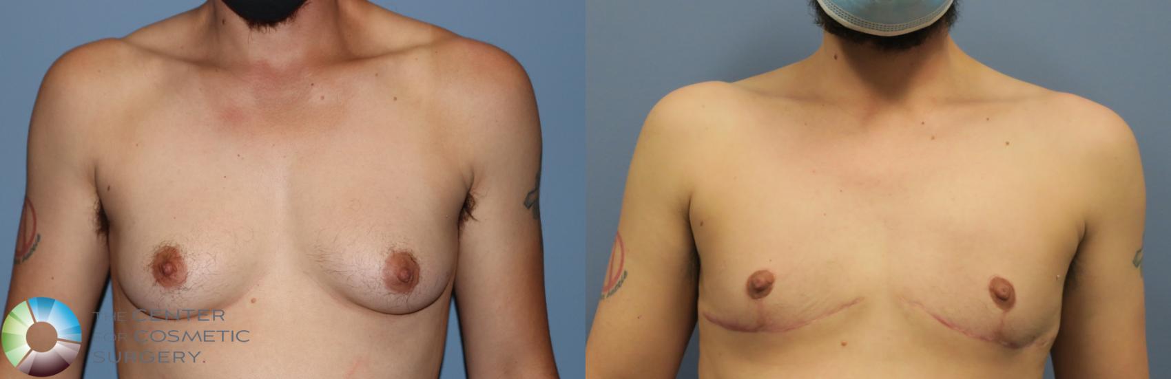 Before & After FTM Top Surgery/Chest Masculinization Case 12046 Front in Denver and Colorado Springs, CO