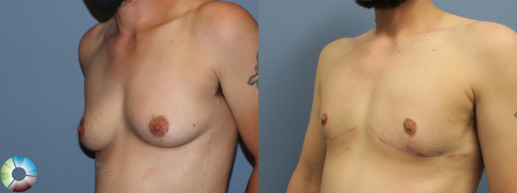 Before & After FTM Top Surgery/Chest Masculinization Case 12046 Left Oblique in Denver and Colorado Springs, CO