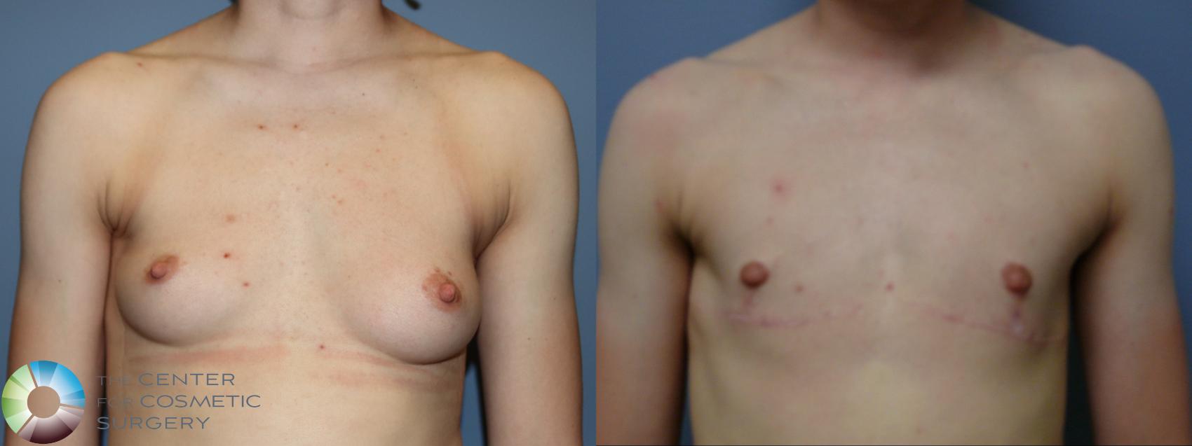 Before & After FTM Top Surgery/Chest Masculinization Case 12047 Front in Denver and Colorado Springs, CO