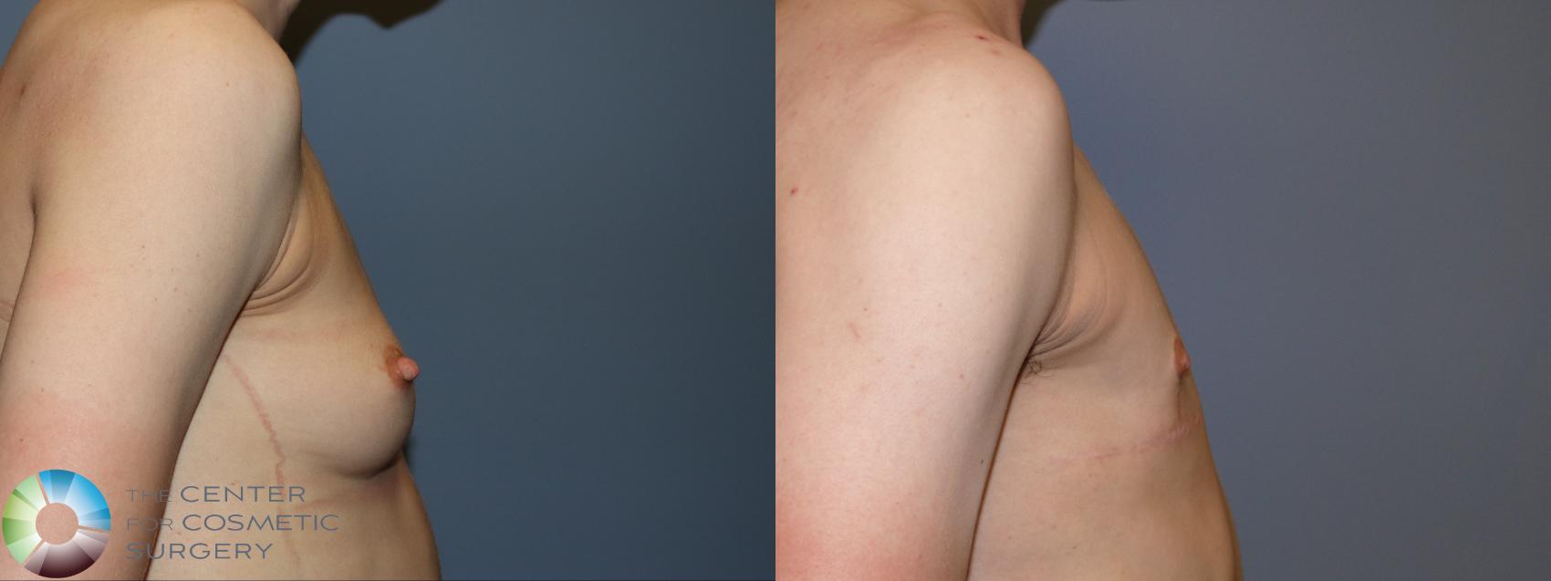 Before & After FTM Top Surgery/Chest Masculinization Case 12047 Right Side in Denver and Colorado Springs, CO