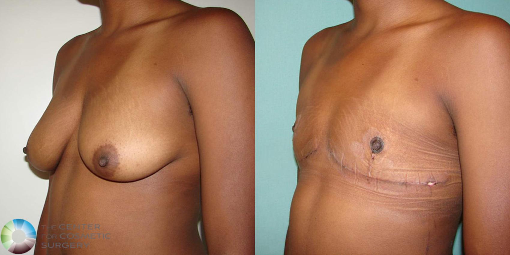 Before & After FTM Top Surgery/Chest Masculinization Case 506 View #3 in Denver and Colorado Springs, CO