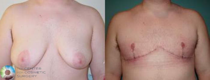 Before & After FTM Top Surgery/Chest Masculinization Case 560 View #1 View in Golden, CO